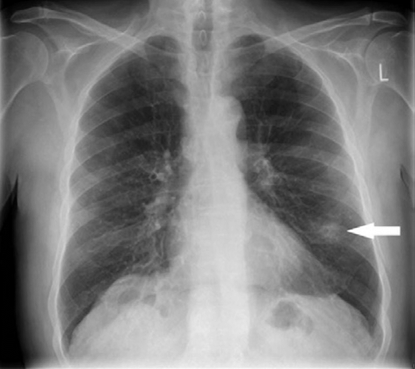 Lung Nodules, Pulmonary Nodules, Investigation Management