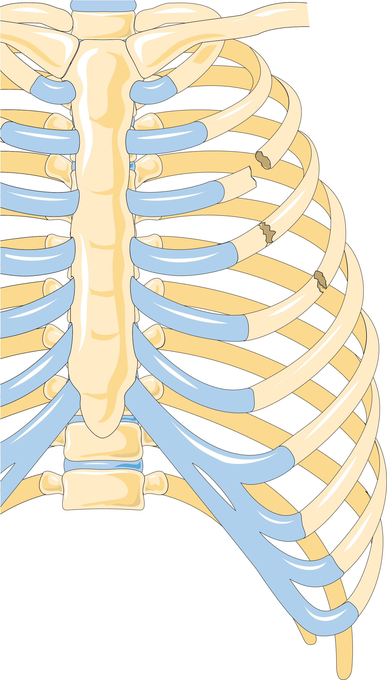 Broken Ribs / Rib Fractures